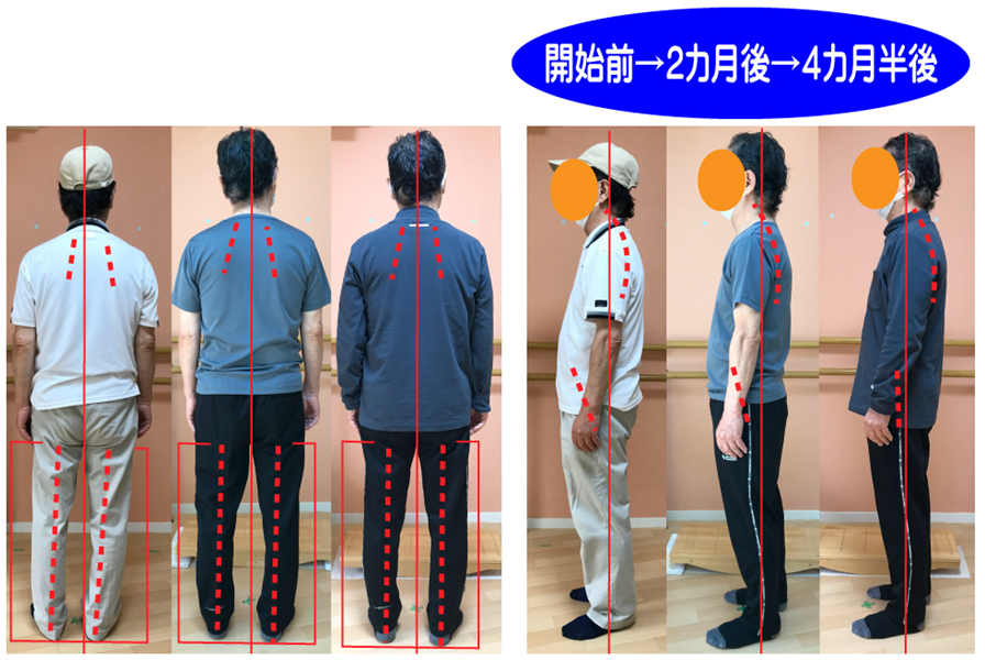 姿勢矯正トレーニングで、側弯症もなおす日本初の運動療法