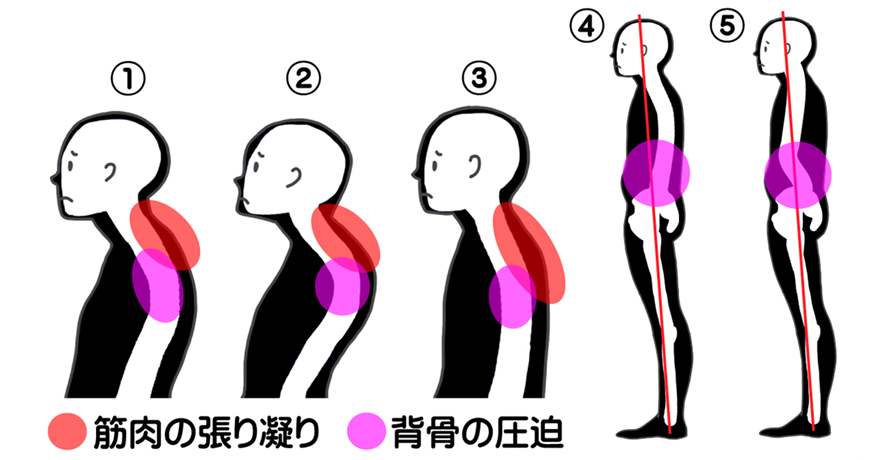 ストレートネックや巻き肩や猫背なぞど、頭が前に出た姿勢は、生理的弯曲が崩れ姿勢矯正が必要である