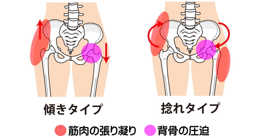 骨盤が傾く、骨盤が捻じれると、脊柱の弯曲だけでなく、脚長差の原因になり姿勢矯正で整える必要がある