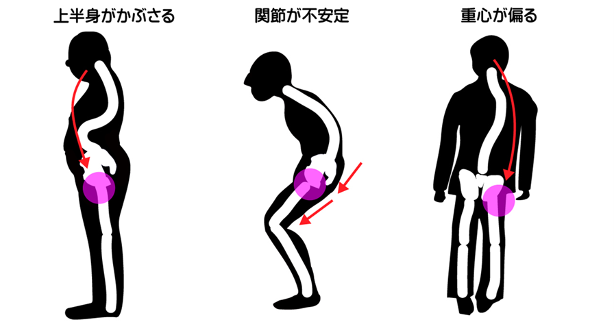 股関節が圧迫される姿勢は、上半身がかぶさる、骨盤後傾で脚関節屈曲、側弯症で片側に重心が寄る姿勢がある