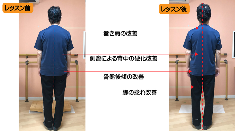 骨盤の捻れを伴った巻き肩で固まった背中を、日本初の姿勢矯正トレーニングのレッスンでここまで改善した