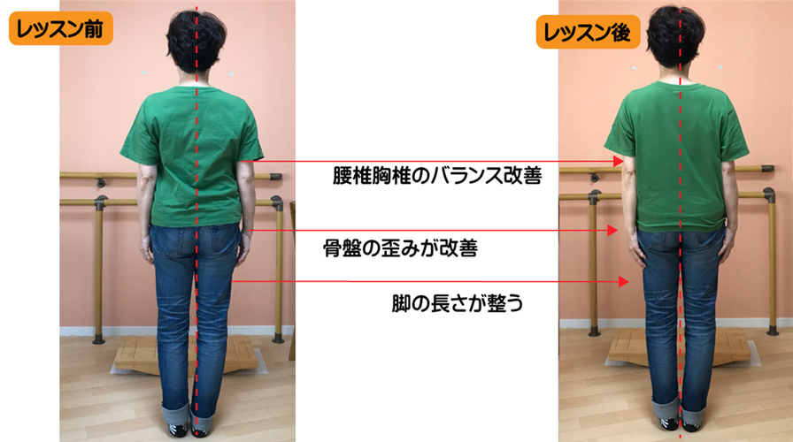 股関節から傾いた脚長差が出やすい側弯症を、日本初の姿勢矯正トレーニングのレッスンでここまで改善した