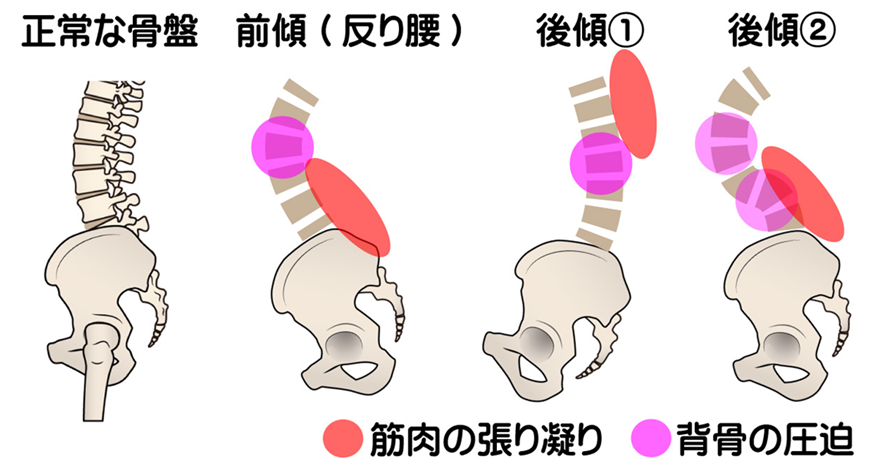 骨盤の前傾や後傾で、骨盤と腰椎の関係性が悪いと腹筋や殿筋、腰椎を支える大腰筋が衰えやすい