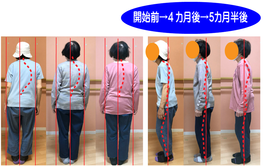 姿勢矯正トレーニングで、姿勢矯正トレーニングで、側弯症もなおす日本初の運動療法