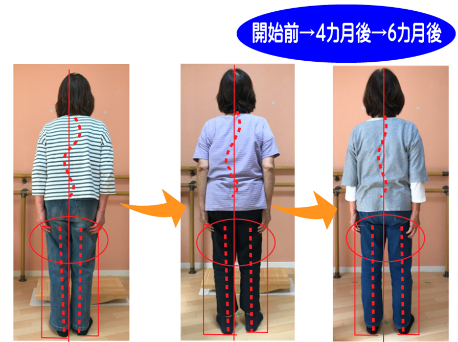 姿勢矯正トレーニングで側弯症もなおす日本初の運動療法