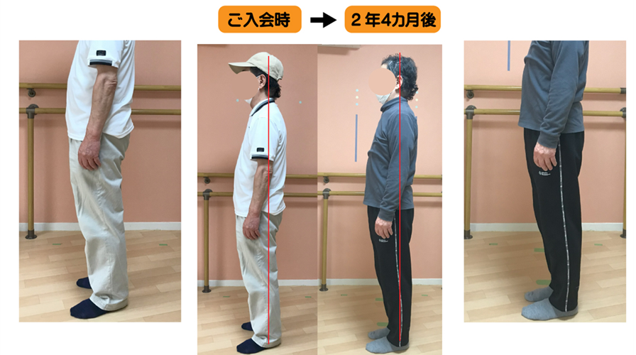 平背とポッコリお腹と下肢筋肉の短縮を、アナトミートレイントレーニングで姿勢改善に成功した例