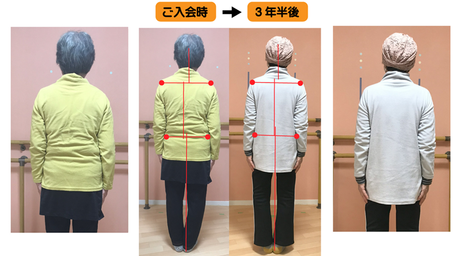 円背で膝が前に出てO脚で脚長差が強かったが、背骨を動きと脚長差を側弯トレーニングで改善した例