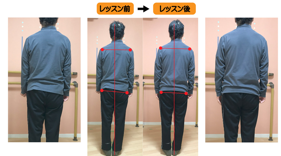 骨盤の歪みと脚長差があり、背骨の捻じれと弯曲で固まった背中の柔軟性を側弯症トレーニングで改善した例