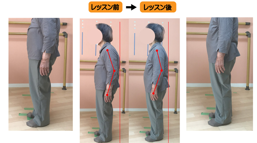 股関節から傾く姿勢で脚長差と脚の太さの違いが顕著な重度の高齢者側弯症をなおす運動療法